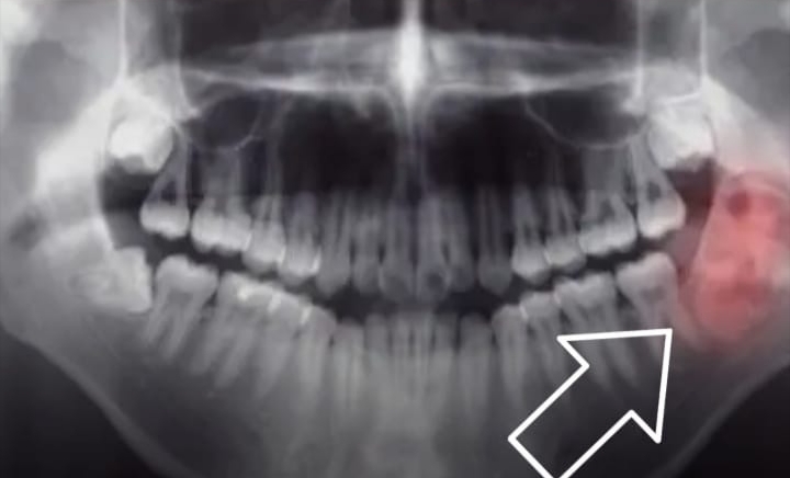 Tumor Bucal