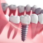Implantes dentales en tijuana mexico