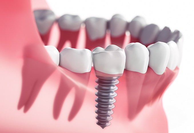 Implantes dentales en tijuana mexico