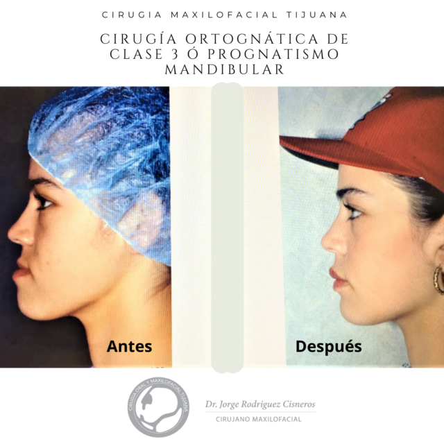 cirugia-ortognatica-clase-3-en-tijuana-maxiofacial-antes-y-despues.png