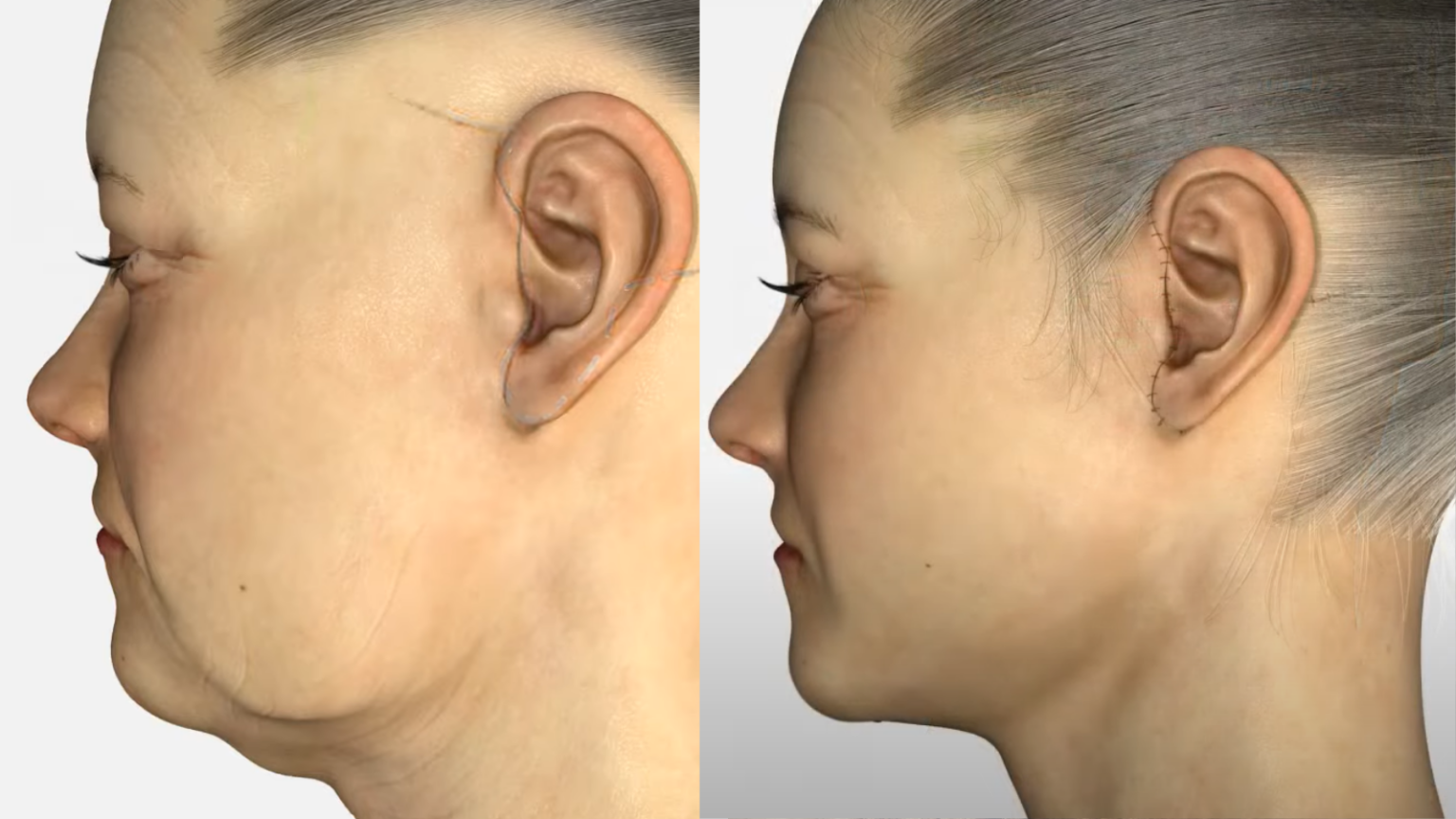 antes-despues-lipopapada-maxilofacial-tijuana.png