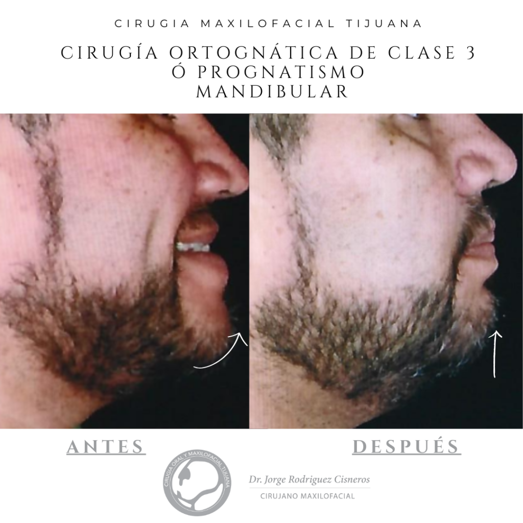 CIRUGIA-ORTOGNATICA-CLASE-3-tijuana-hombre-antes-y-despues-maxilofacial.