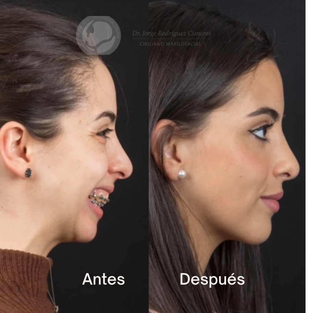 cirugia-ortognatica-clase-2-retrognatismo-mandibular-tijuana-mexico-antes-despues-maxilofacia
