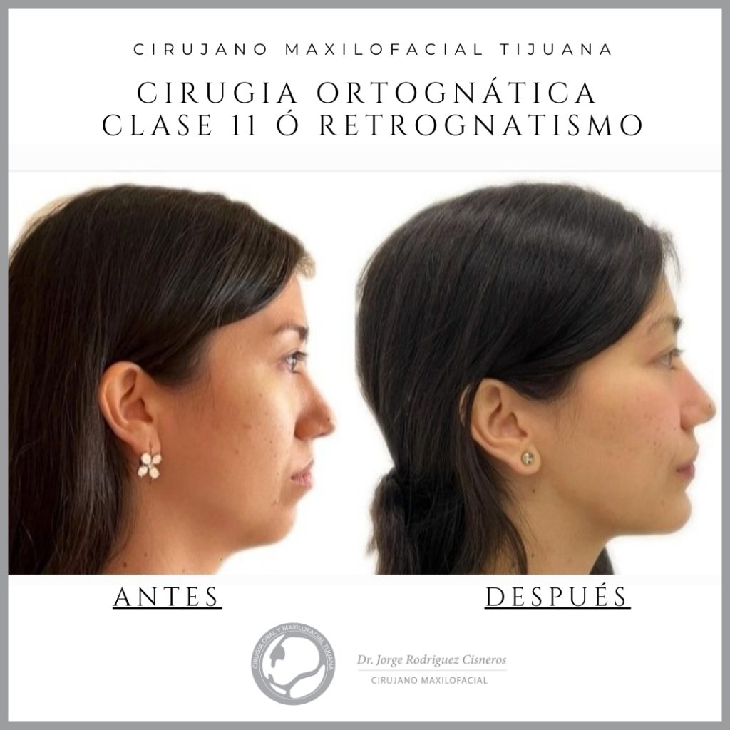 CIRUGIA-ORTOGNATICA-CLASE-11-O-retrognatismo-tijuana-maxilofacial