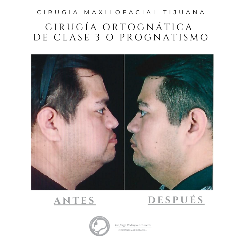 CIRUGIA-ORTOGNATICA-CLASE-3-maxilofacial-tijuana