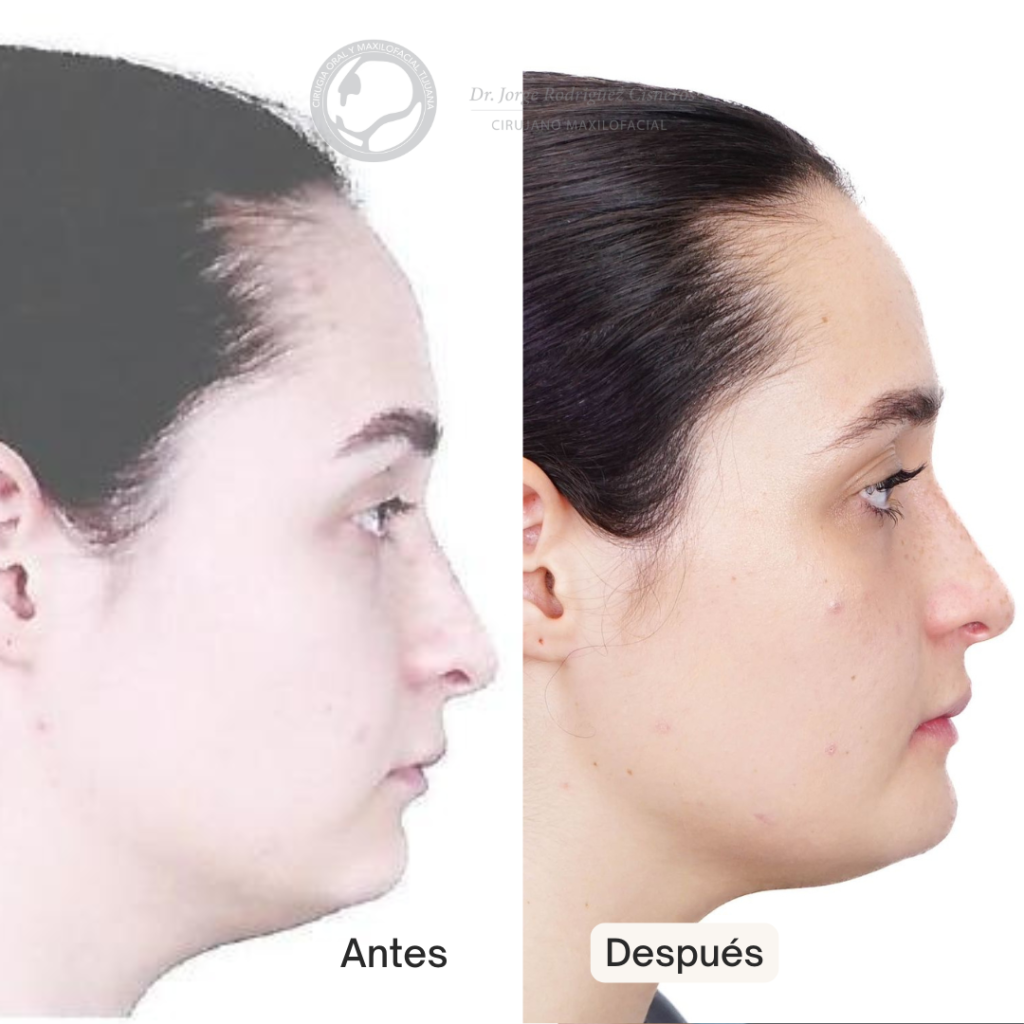 antes-despues-cirugia-ortognatica-tijuana-maxilofacial-rodriguez-jorge-cisneros-mexico