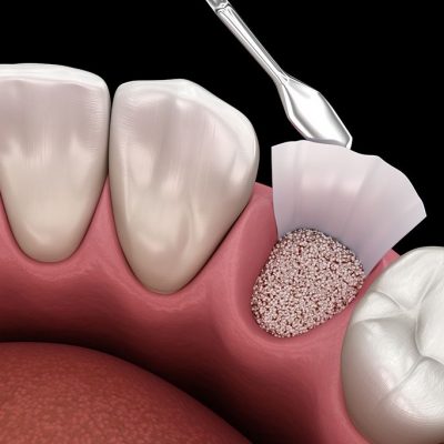 Injerto de hueso dental en Tijuana Mexico